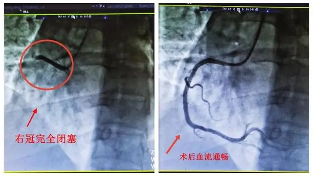 阳性一个月后肺栓塞风险增加33倍 深静脉血栓形成的风险也增加了5倍