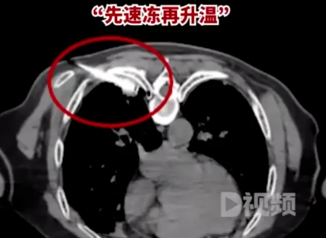 医生用一根针帮患癌老人冻死肿瘤（痛苦明显减轻，恢复良好）